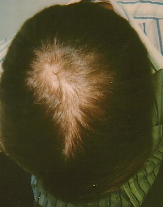 Hair-loss regrowth